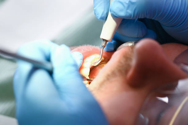 Best Emergency Root Canal Treatment in Naples, TX